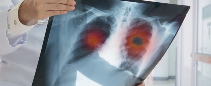 Lungenkrebs trifft Frauen immer häufiger Lungenkrebs trifft Frauen immer häufiger