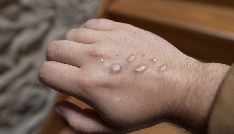 Hand Ausschlag Affenpocken Istock 1399004693(1)